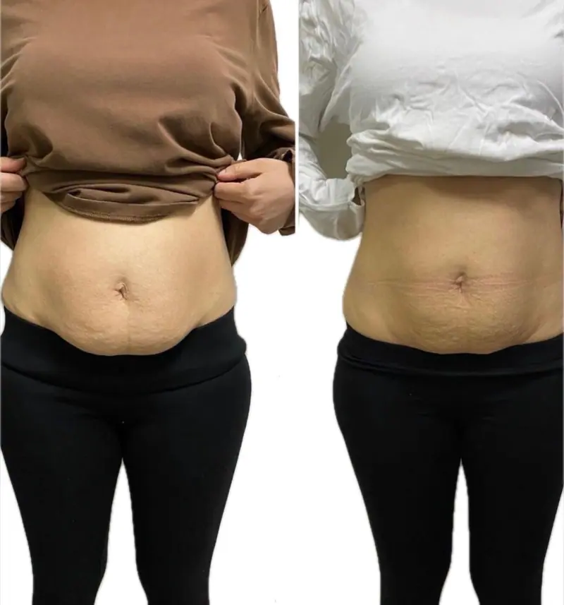 Body sculpting results — Belly Fat Reduction
