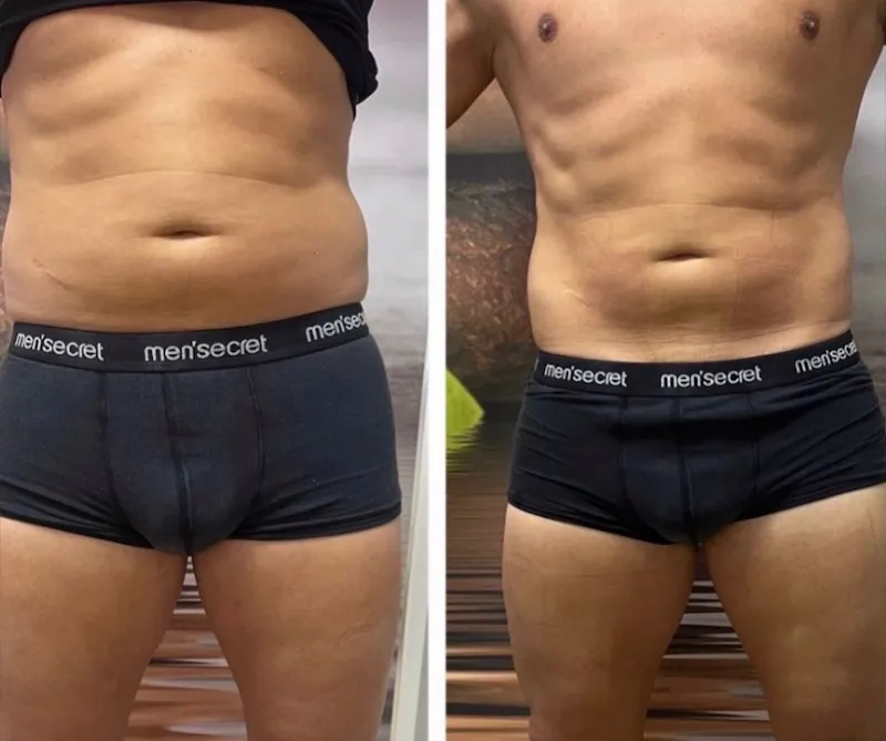 Body sculpting results — Love Handles