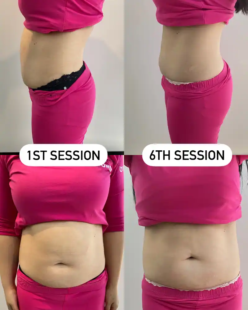 Body sculpting results — Waist